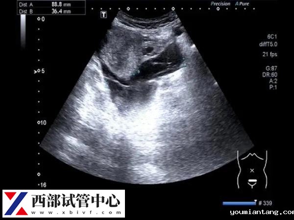 卵黄囊通常在怀孕的第5到第10周之间可见