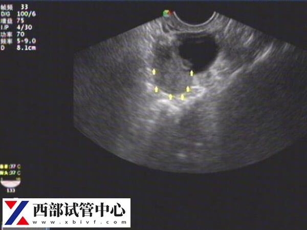 残角子宫怀孕几率相对较小,教你3招或有帮助(图1) 残角子宫能不能成功怀孕