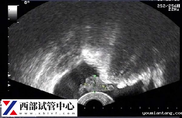 囊胚移植一超没有卵黄囊二超可能会有